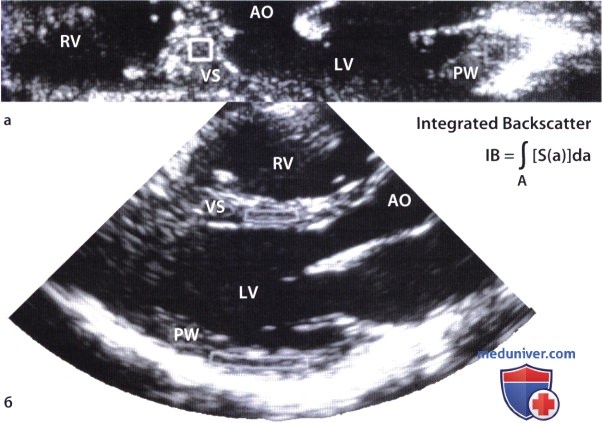 Эхокардиографическая характеристика тканей при миокардите и реакции отторжения сердца