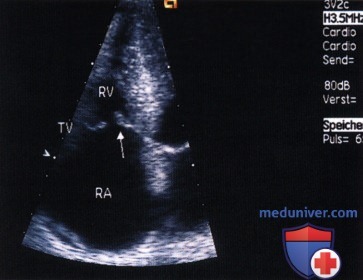 ЭхоКГ трикуспидального (трехстворчатого) клапана сердца