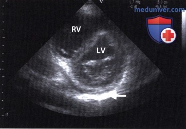 ЭхоКГ в реанимации (ОРИТ) при эмболии легочной артерии (остром легочном сердце)