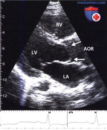 ЭхоКГ при врожденном стенозе аортального клапана (двустворчатом аортальном клапане)