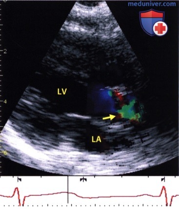 ЭхоКГ при врожденном стенозе аортального клапана (двустворчатом аортальном клапане)