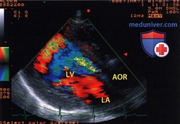 ЭхоКГ при врожденной недостаточности аортального клапана