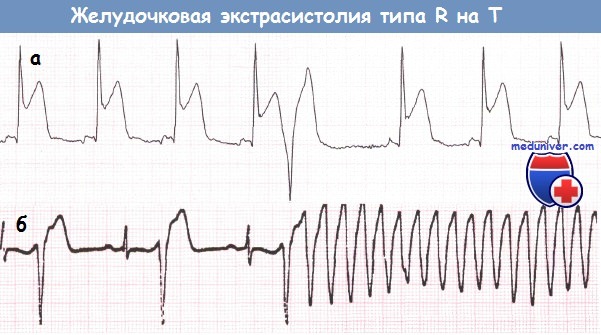 Желудочковая тахикардия после инфаркта thumbnail
