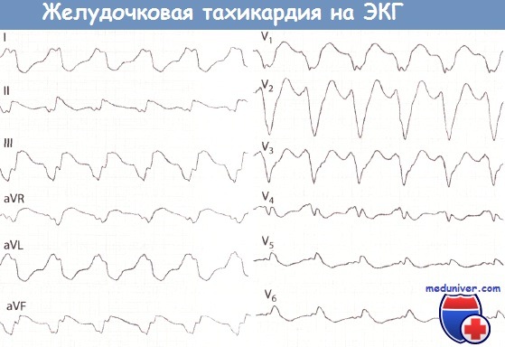 Нарушение ритма сердца при инфаркте миокарда thumbnail