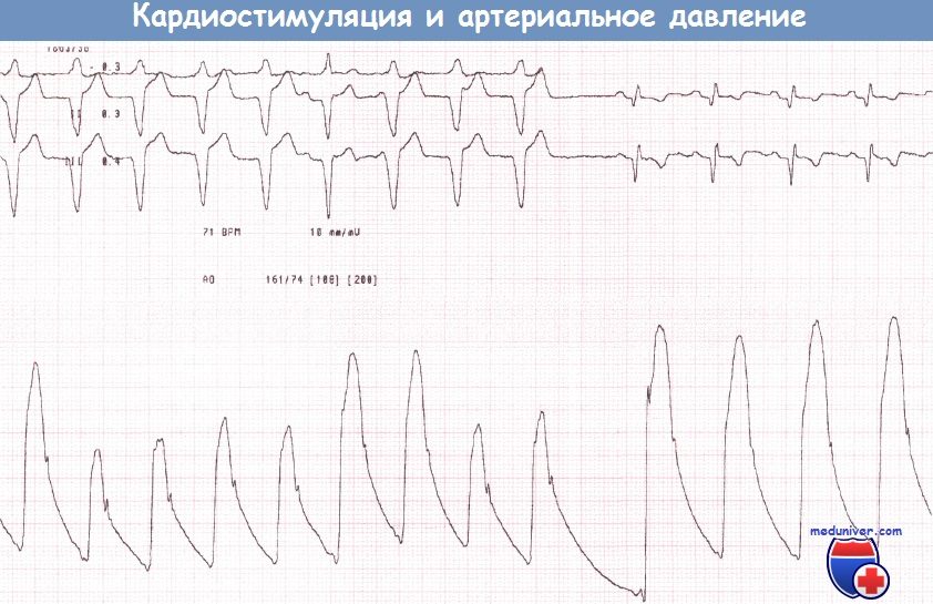 Электрокардиостимуляция и артериальное давление