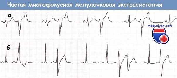 Причиной инфаркта миокарда является фибрилляция thumbnail