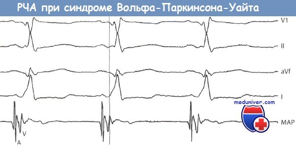 Катетерная радиочастотная аблация при синдроме Вольфа-Паркинсона-Уайта