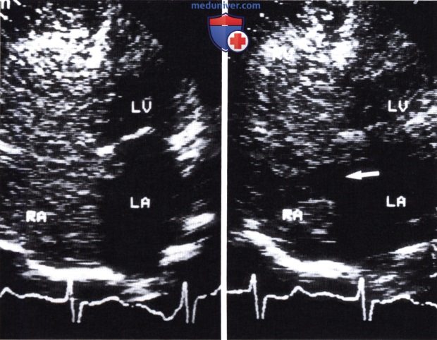 Диагностика шунтов сердца (ДМПП, ООО, ПАФ) контрастной эхокардиографией