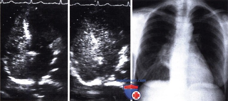 Диагностика шунтов сердца (ДМПП, ООО, ПАФ) контрастной эхокардиографией