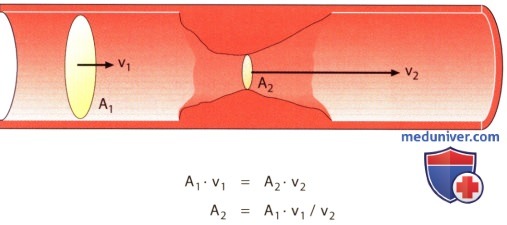 Применение теоремы сохранения массы к случаям сужения поперечного сечения потока в эхокардиографии (ЭхоКГ)