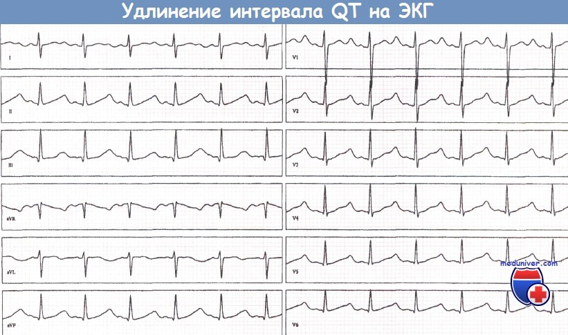 Удлинение qt. Синдром удлиненного интервала qt на ЭКГ. ЭКГ С синдромом удлиненного интервала qt у детей. Удлиненный интервал qt на ЭКГ что это такое. Синдром удлиненного интервала qt ЭКГ снимок.