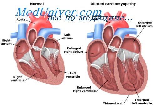 Левожелудочковая сердечная недостаточность классификация thumbnail