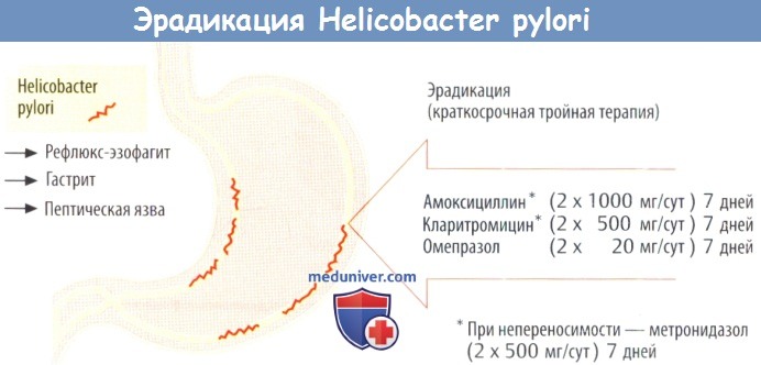Схема эрадикации Helicobacter pylori