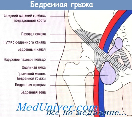 Анатомия бедренной грыжи