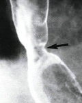 рентген пищевода при болезни