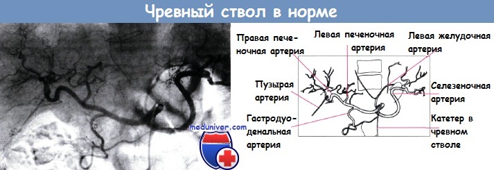 Анатомия чревного ствола в норме