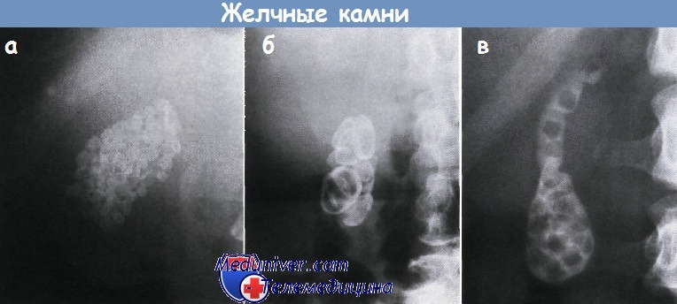 Рентгенологические методы исследования желчного пузыря thumbnail