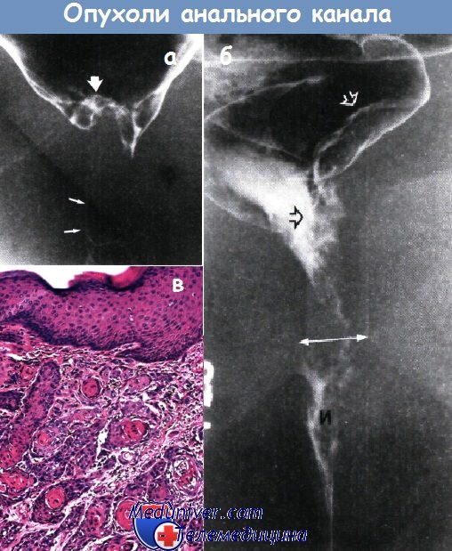 Рак анального канала - диагностика, лечение | Онкологические заболевания органов ЖКТ