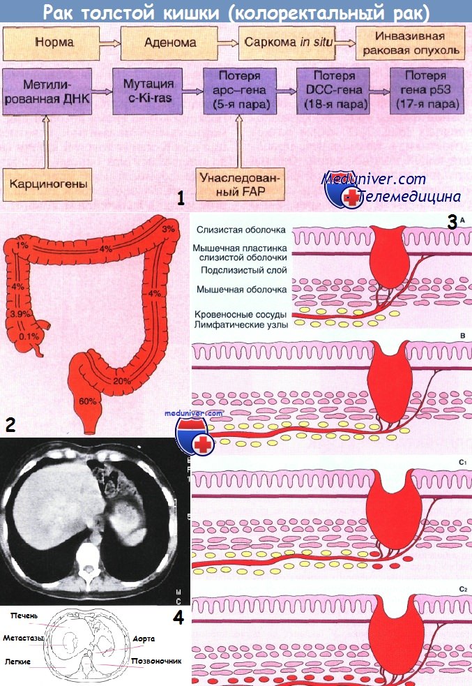 peritonealis rák lynch szindróma