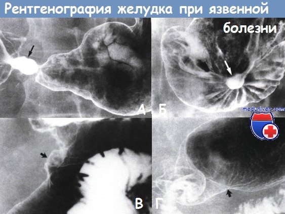 Рентгенография желудка при язвенной болезни