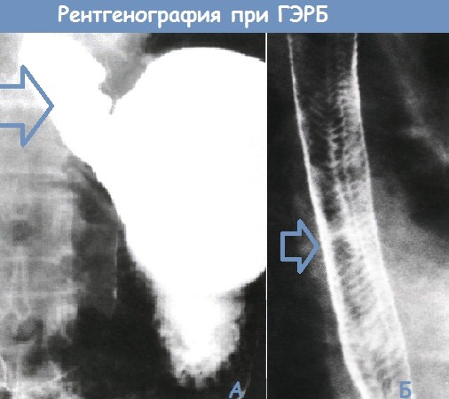 rentgenografia pri gerb