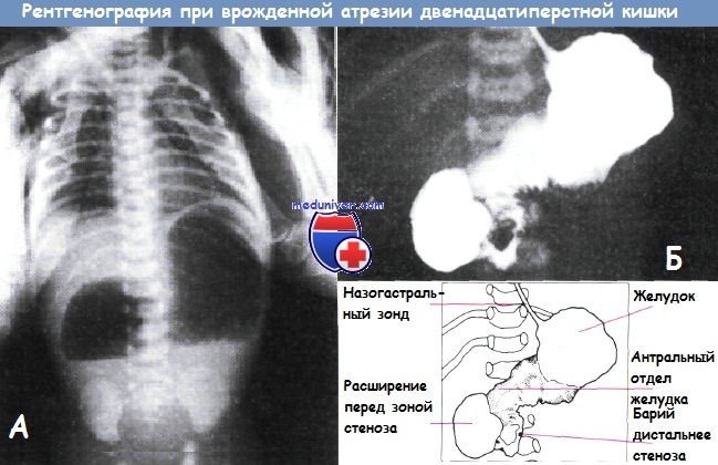 Рентгенография при врожденном стенозе двенадцатиперстной кишки