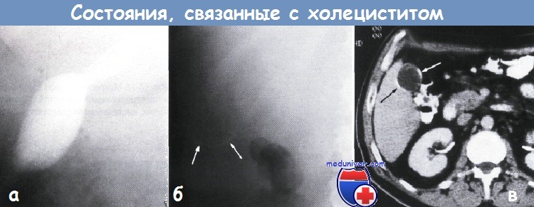 Картина холецистита. Рентген брюшной полости при холецистите. Фарфоровый желчный пузырь рентген. Холицистоз гонгренальный.