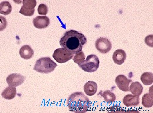 Гемолитическая анемия с холодовыми антителами thumbnail