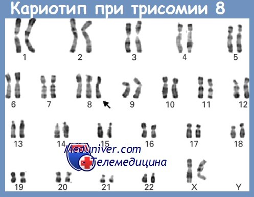 Кариотип при трисомии 8-й хромосомы