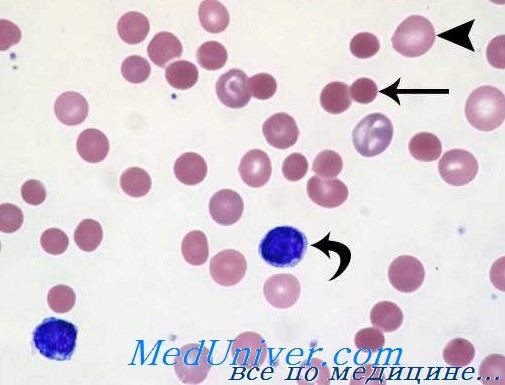 мазок крови при гемолитической анемии