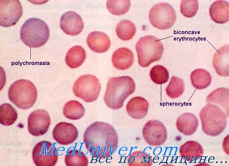 Сфероцитозе других видах сфероцитарных анемий thumbnail