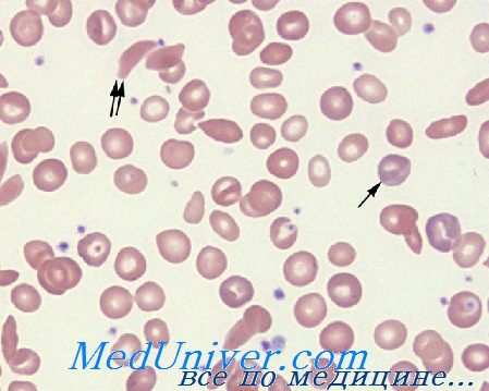Анализ крови при серповидноклеточной анемии thumbnail