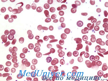 сиклемия - серповидноклеточная анемия
