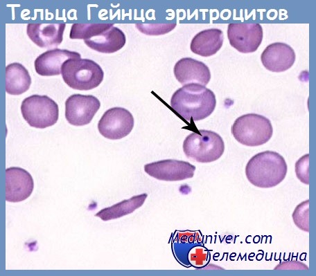 Тельца гейнца в анализе крови как обозначается thumbnail