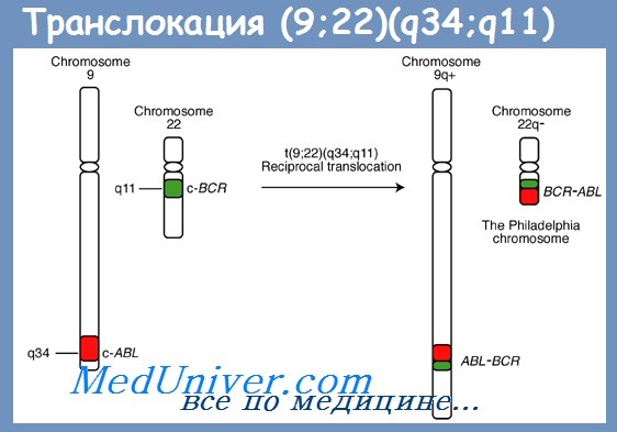 Транслокация 9 и 22 - t(9;22) — филадельфийская хромосома