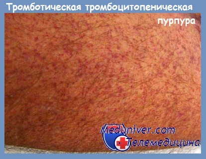 Тромботическая тромбоцитопеническая пурпура