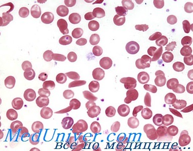 Мазок крови при серповидно-клеточной анемии