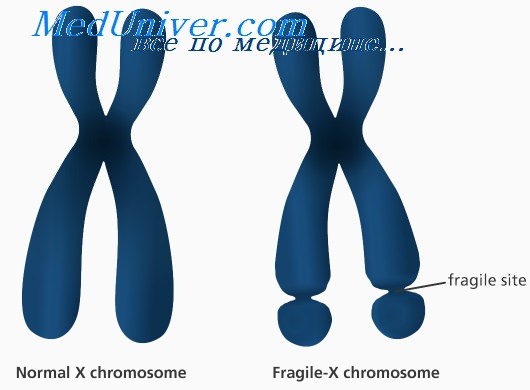 синдром ломкой Х-хромосомы