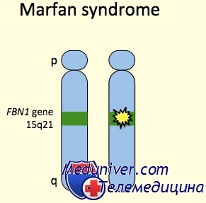 Генетика синдрома Марфана