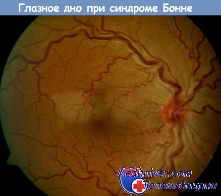 синдром Бонне - глазное дно