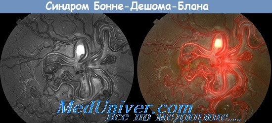 синдром Бонне-Дешома-Блана - глазное дно