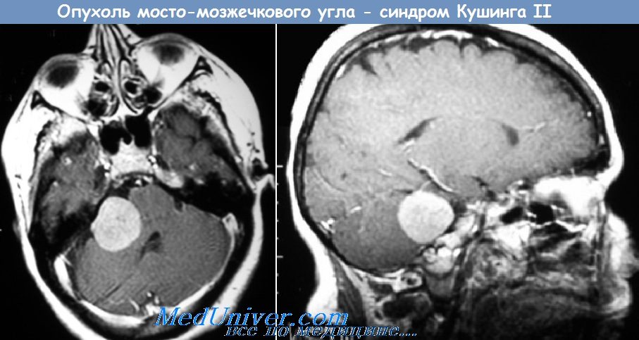 опухоль мосто-мозжечкового угла - синдром Кушинга II