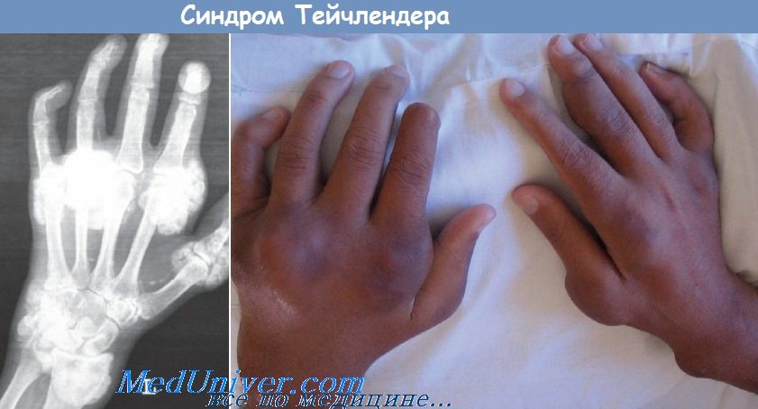 Прогрессирующий липокальциногранулематоз или синдром тейчлендера thumbnail