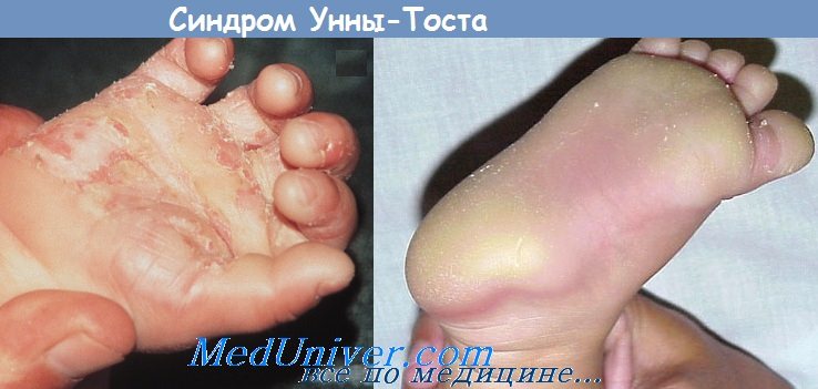 синдром Унны-Тоста
