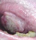 рак полости рта