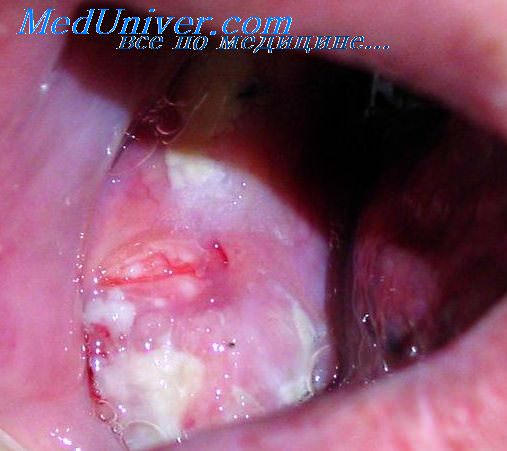 фиброма полости рта