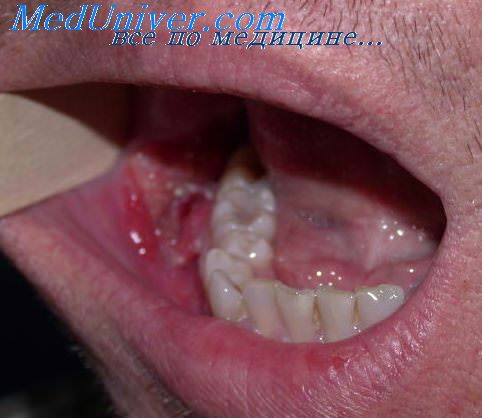миксома полости рта