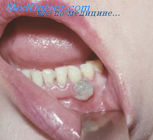 эпулис полости рта