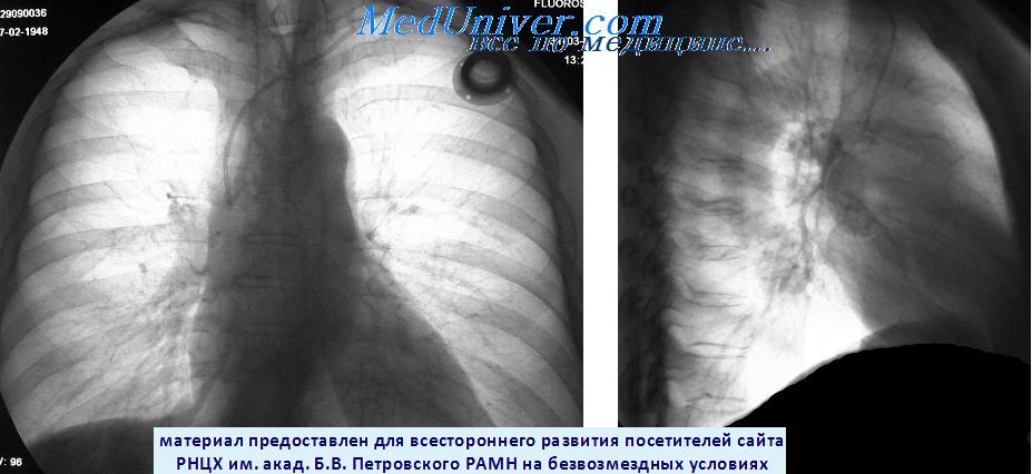 Рентгенограмма метастаза рака в нижнею долю правого легкого