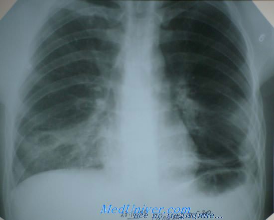 Фотография: Рентгеновский снимок при пневмонии.